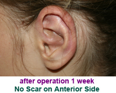 plastic-surgery-prominent-ear 